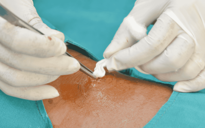 incisionanddrainage